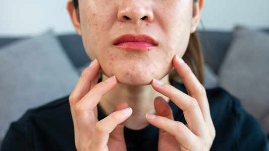 Why Is My Face So Oily? And What to Do About It